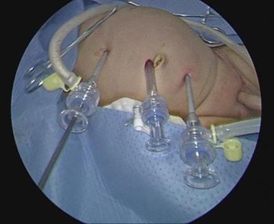 Laparoscopic pyeloplasty for newborns with severe hydronephrosis